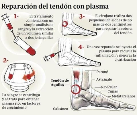 Tratamiento para la tendinitis de aquiles